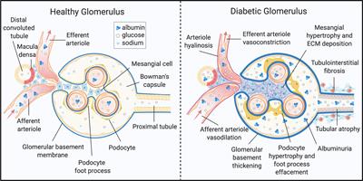 Rotten to the Cortex: Ceramide-Mediated Lipotoxicity in Diabetic Kidney Disease